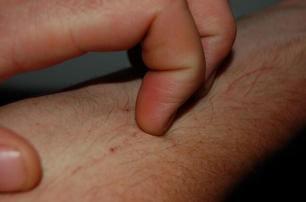 kruarja e lëkurës si simptomë e pranisë së parazitëve